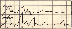 A line graph showing muscle contractions during a series of simple bow strokes executed with excessive tension in the shoulder