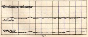 Sketch showing the activity of the pectoralis and latissimus dorsi muscles when playing with a properly controlled application of force.