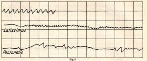 Line graph demonstrating increased tension in the same muscles at exactly the same spot and with the same volume when using physiologically incorrect technique